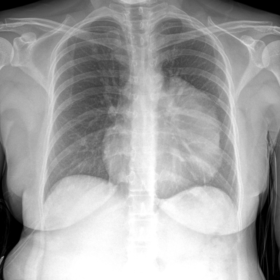 Chest X-ray